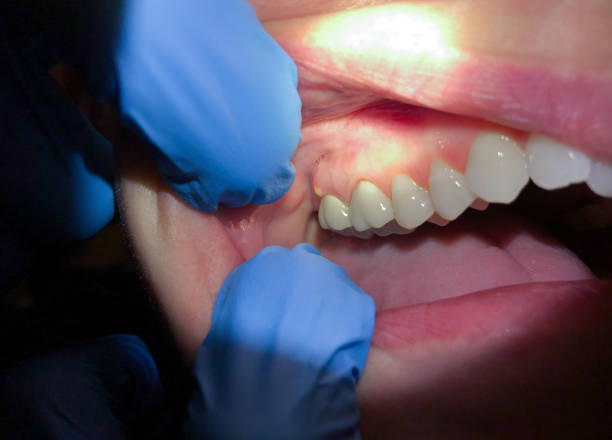 Best Emergency Treatment for Oral Infections in Fairfield Bay, AR